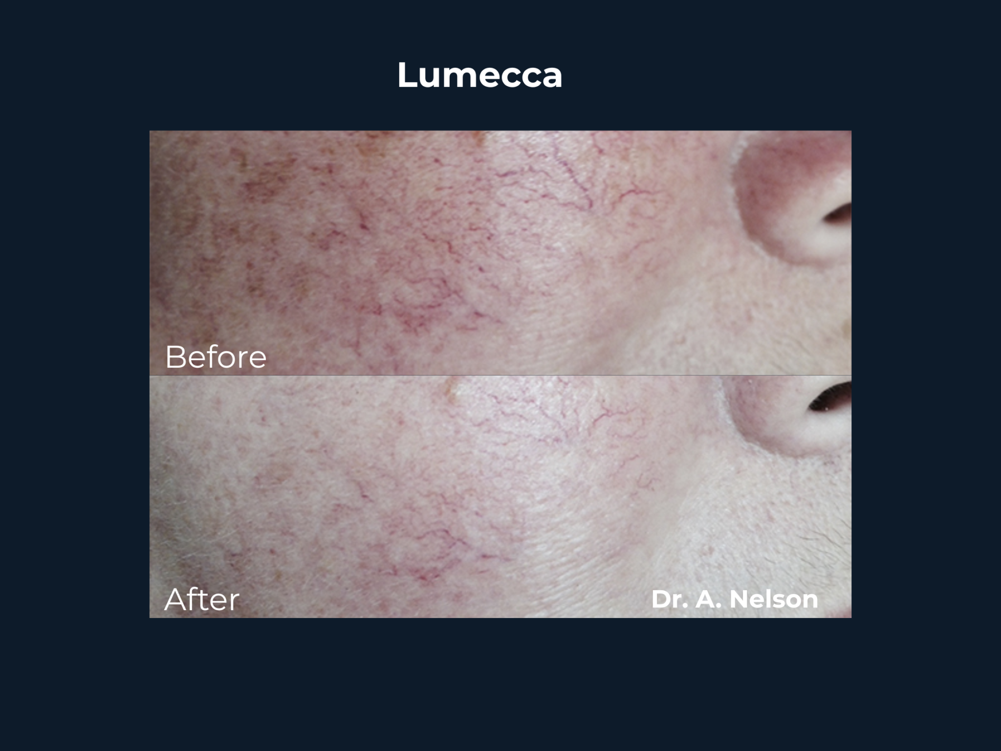 lumecca 2