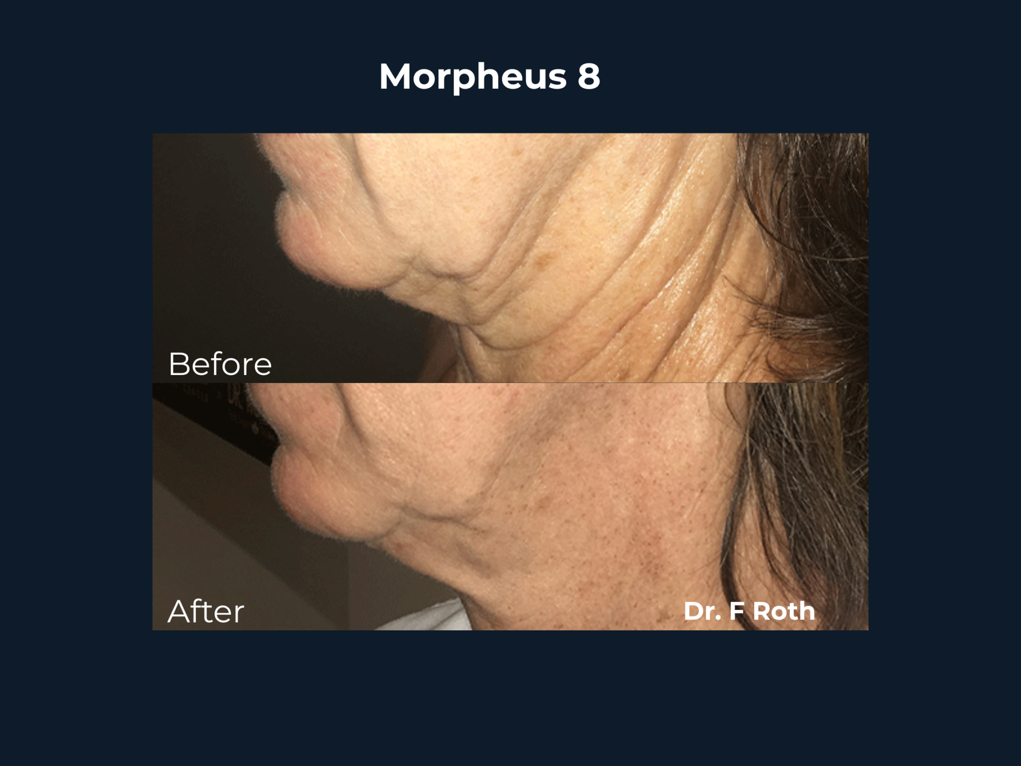 morpheus 8 (1)