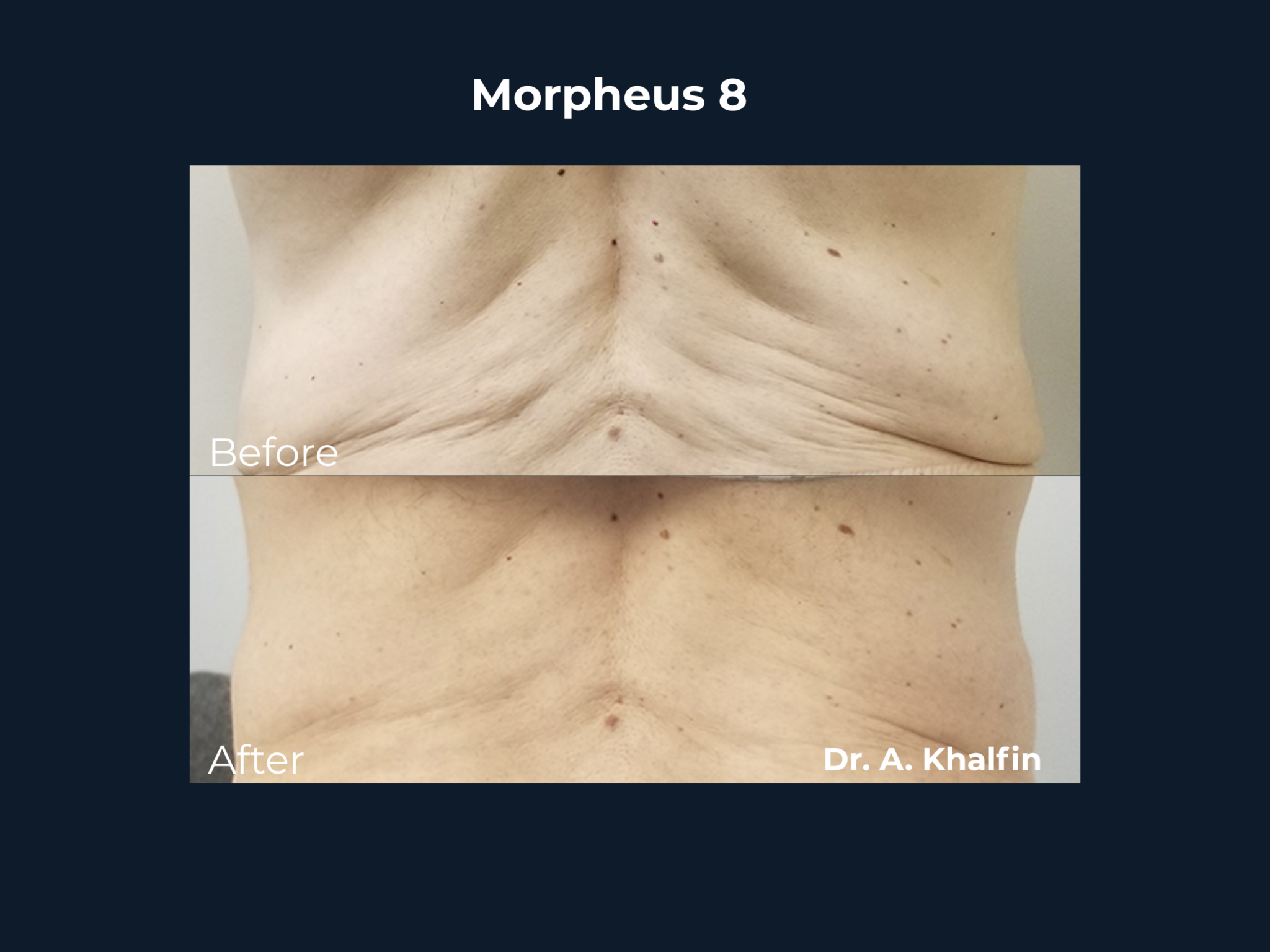morpheus 8